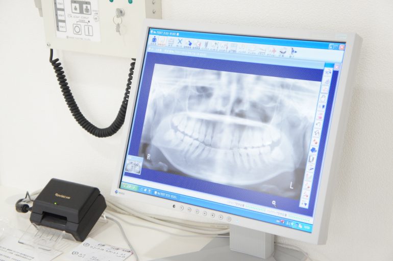 レントゲンで歯槽骨の状態を確認する