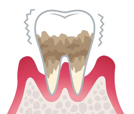 歯周病とは